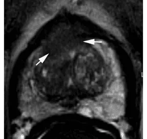 Same as above, but ≥1.5cm in greatest dimension or definite extraprostatic extension/invasive behavior