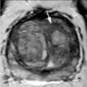 A homogeneous mildly hypointense area between nodules