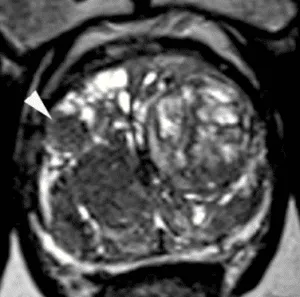 Atypical nodule (homogeneous circumscribed nodule without encapsulation)