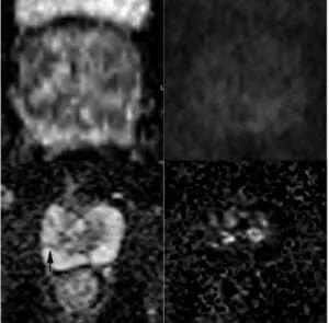 Linear/wedge shaped hypointense on ADC and/or linear/wedge shaped hyperintense on high b-value DWI