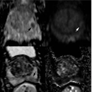 Focal (discrete and different from the background) hypointense on ADC and/or focal hyperintense on high b-value DWI (may be markedly hypointense on ADC or markedly hyperintense on high b-value DWI, but not both)