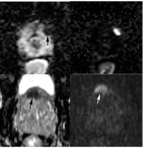 Focal markedly hypontense on ADC AND markedly hyperintense on high b-value DWI AND <1.5cm in greatest dimension