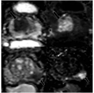 Focal markedly hypontense on ADC AND markedly hyperintense on high b-value DWI AND  ≥1.5cm in greatest dimension or definite extraprostatic extension/invasive behavior