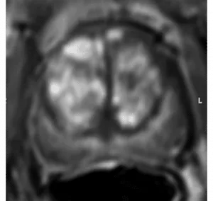 Diffuse multifocal enhancement NOT corresponding to a focal finding on T2W and/or DWI