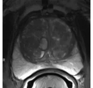 Focal enhancement corresponding to a lesion demonstrating features of BPH on T2WI (including features of extruded BPH in the PZ)