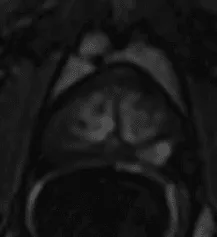 Focal and earlier than or contemporaneously with enhancement of adjacent normal prostatic tissues, and; corresponds to suspicious finding on T2W and/or DWI