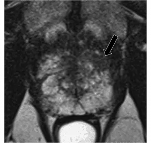 Circumscribed, homogenous moderate hypointensity confined to prostate AND <1.5 cm in greatest dimension