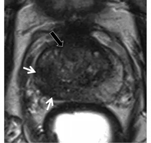 Circumscribed, homogenous moderate hypointensity confined to prostate AND ≥1.5cm in greatest dimension or definite extraprostatic extension/invasive behavior