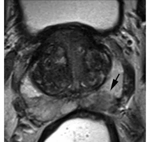 Non-circumscribed, rounded, moderate hypointensity