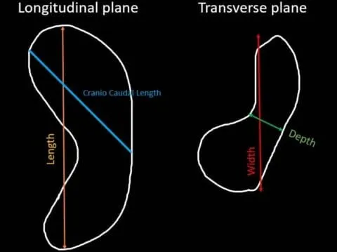 How to measure spleen dimensions in ultrasound