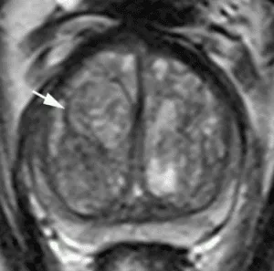 Typical nodule (round, completely encapsulated nodule)