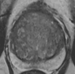 Normal appearing transitional zone