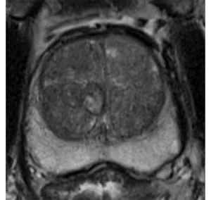 A mostly encapsulated nodule