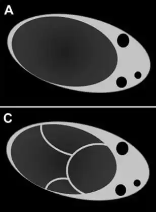 Cystic* lesion WITHOUT solid component(s)