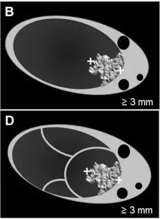 Cystic* lesion WITH solid component(s)