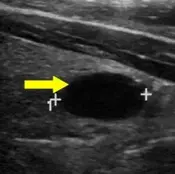 Anechoic (cystic or almost completely cystic nodules)