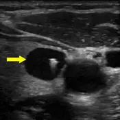 Cystic or almost completely cystic