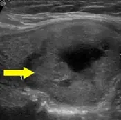 Hyperechoic or isoechoic