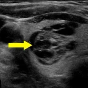 Spongiform (>50% small cysts)