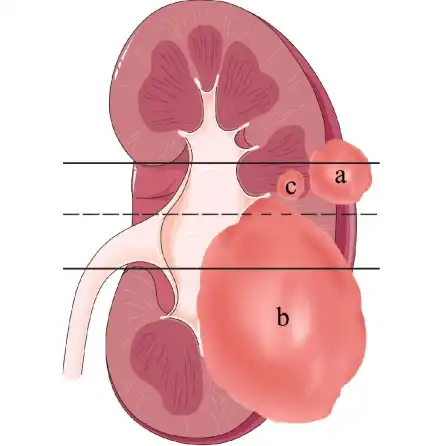 >50% of mass is across polar line (a) or mass crosses the axial renal midline (b) or mass is entirely between the polar lines (c)