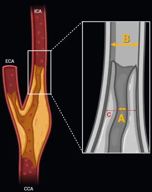 nascet calculator by radathand.com ecst carotid stenosis ica cta mra
