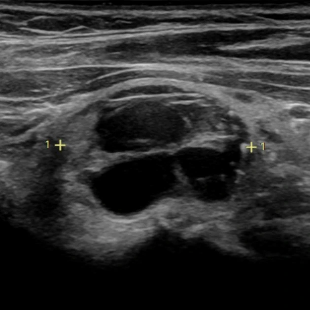 Cystic, almost completely cystic, or spongiform