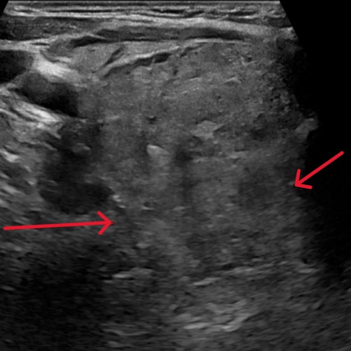 Extra-thyroidal extension