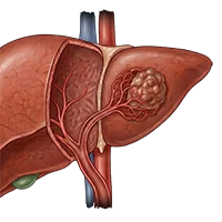 Lutathera Dose Modification for Adverse Reactions