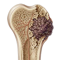 Neuroblastoma mIBG Curie Score