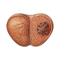 Pluvicto Dose Modification for Adverse Reactions