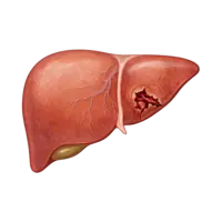 AAST Liver Trauma