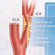 Grading calculator for internal carotid artery stenosis using nascet criteria