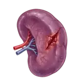 spleen injury grading calculator for splenic trauma using aast guidelines 2