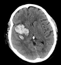 ich volume calculator for intracranial hemorrhage