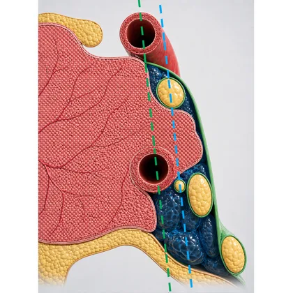 Lateral to the lateral tangent, above the intracavernous ICA