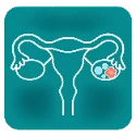 O-RADS Calculator for adnexal mass evaluation on ultrasound and MRI