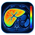 MRI liver iron quantification image illustrating hepatic iron measurement using R2* or T2* methods