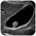 SRU Gallbladder Polyp Calculator (2022 Guidelines) SRU gallbladder polyp calculator calculator for follow up recommendations on galbladder polyps based on SRU guidelines