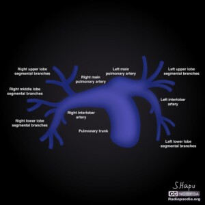 Case courtesy of Sachi Hapugoda, Radiopaedia.org, rID: 56326 pulmonary artery anatomy