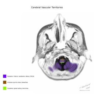 Case courtesy of Frank Gaillard, Radiopaedia.org, rID: 10814 cerebral vascular territories diagram