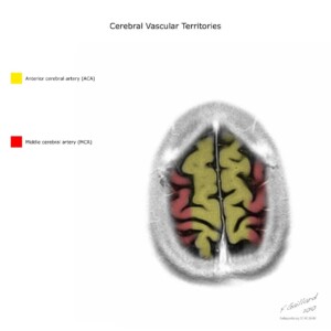 Case courtesy of Frank Gaillard, Radiopaedia.org, rID: 10814 cerebral vascular territories diagram