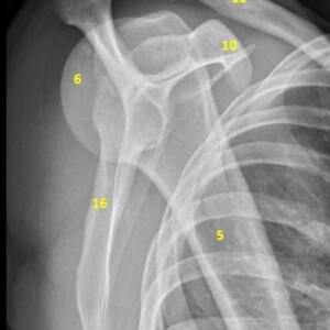 1. anatomical neck of humerus
2. greater tuberosity
3. lesser tuberosity
4. surgical neck of humerus
5. humeral shaft
6. humeral head
7, glenoid fossa
8. acromion
9. acromioclavicular joint
10. coracoid process
11. clavicle
12.superior angle of scapula
13. medial border of scapula
14. inferior angle of scapula
15. lateral border of scapula
16. scapula shoulder radiograph annotated