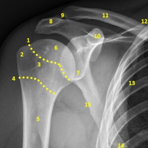 1. anatomical neck of humerus
2. greater tuberosity
3. lesser tuberosity
4. surgical neck of humerus
5. humeral shaft
6. humeral head
7, glenoid fossa
8. acromion
9. acromioclavicular joint
10. coracoid process
11. clavicle
12.superior angle of scapula
13. medial border of scapula
14. inferior angle of scapula
15. lateral border of scapula
16. scapula shoulder radiograph annotated