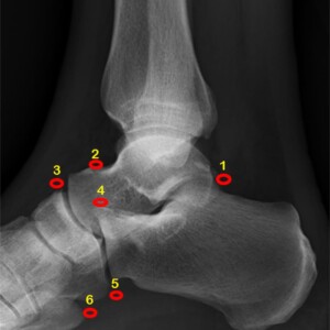 Common accessory ossicles ot the foot:
1.	os trigonum
2.	os supratalare
3.	os supranaviculare
4.	os calcaneus secundaris
5.	os peroneum
6.	os vesalianum
7.	os tibiale externum
8.	os intercuneiforme
9.	os intermetatarseum ankle radiograph annotated