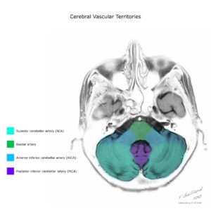 Case courtesy of Frank Gaillard, Radiopaedia.org, rID: 10814 cerebral vascular territories diagram