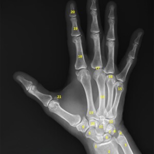 1.	Styloid process of radius.
2.	Metaphysis of radius.
3.	Metaphysis of ulna.
4.	Styloid process of ulna.
5.	Scaphoid.
6.	Lunate.
7.	Triquetrum.
8.	Pisiform.
9.	Trapezium.
10.	Trapezoid.
11.	Capitate.
12.	Hamate.
13.	Base of second metacarpal.
14.	Shaft of third metacarpal.
15.	Neck of fifth metacarpal.
16.	Head of forth metacarpal.
17.	Metacarpophalangeal joint.
18.	Proximal phalanx.
19.	Middle phalanx.
20.	Distal phalanx.
21.	Sesamoid bones (flexor pollicis brevis, adductor pollicis).
22.	Terminal tuft hand radiograph annotated