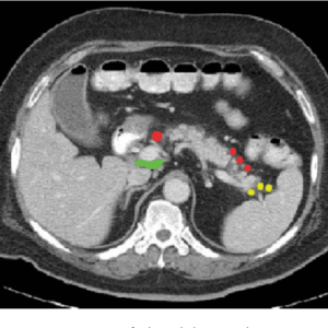 Yellow: splenic -- Green: periportal -- Red: anterior pancreatic -- Orange: hepatic Radiology abdominal lymph node stations