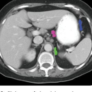 Pink: Left gastric -- Blue: greater curvature -- Green: left inferior phrenic Radiology abdominal lymph node stations