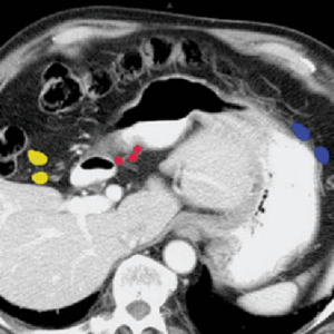 Blue: greater curvature -- Red: right gastric -- Yellow right colic Radiology abdominal lymph node stations
