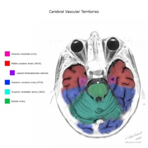 Case courtesy of Frank Gaillard, Radiopaedia.org, rID: 10814 cerebral vascular territories diagram